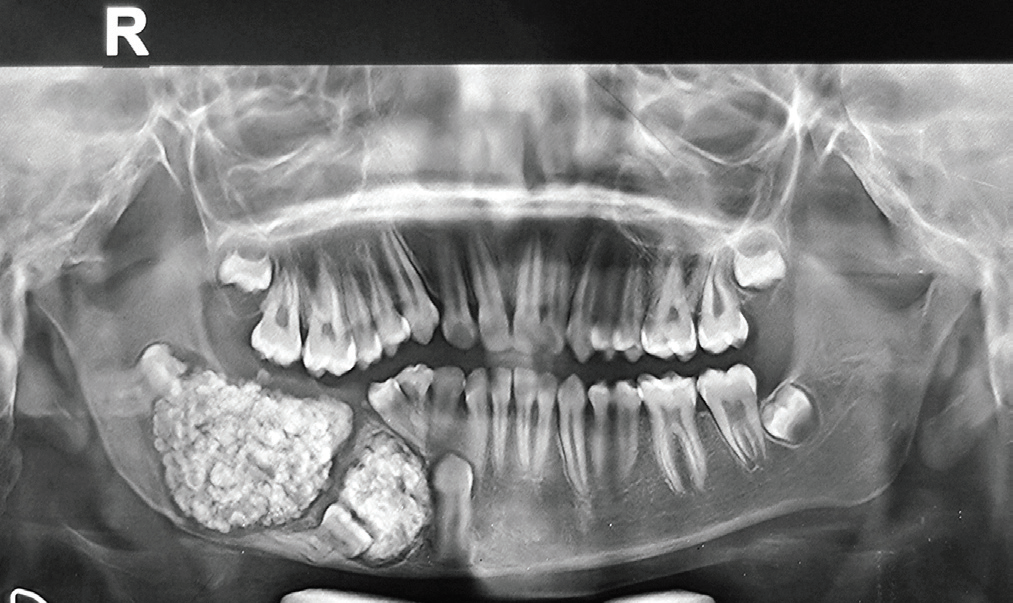 Complex Composite Odontoma Complex Composite Odontoma